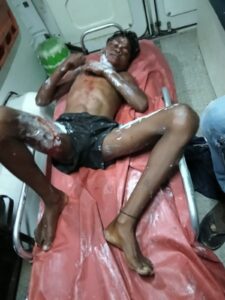 हाईटेंशन करंट का कहर: 11 हजार वोल्ट की चपेट में आया किशोर, 70% झुलसा